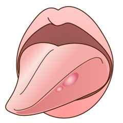 舌のできもの